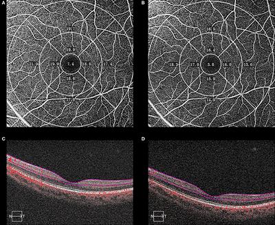 Macular Vessel Density Changes in Young Adults With High Myopia: A Longitudinal Study